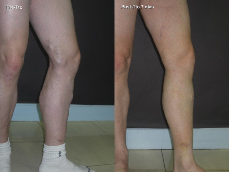 Nuevo tratamiento para eliminar varices con láser permite salir andando tras la intervención