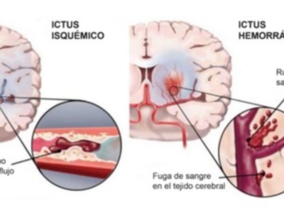 El ictus se convierte en la segunda causa de muerte según la OMS